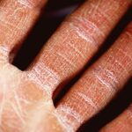 découvrez tout ce que vous devez savoir sur l'eczéma : causes, symptômes, traitements et conseils pour soulager cette affliction cutanée. apprenez à mieux gérer votre peau et à minimiser les poussées d'eczéma pour un confort quotidien.