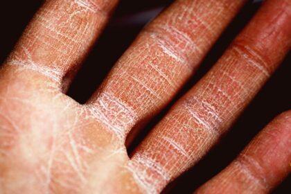 découvrez tout ce que vous devez savoir sur l'eczéma : causes, symptômes, traitements et conseils pour soulager cette affliction cutanée. apprenez à mieux gérer votre peau et à minimiser les poussées d'eczéma pour un confort quotidien.