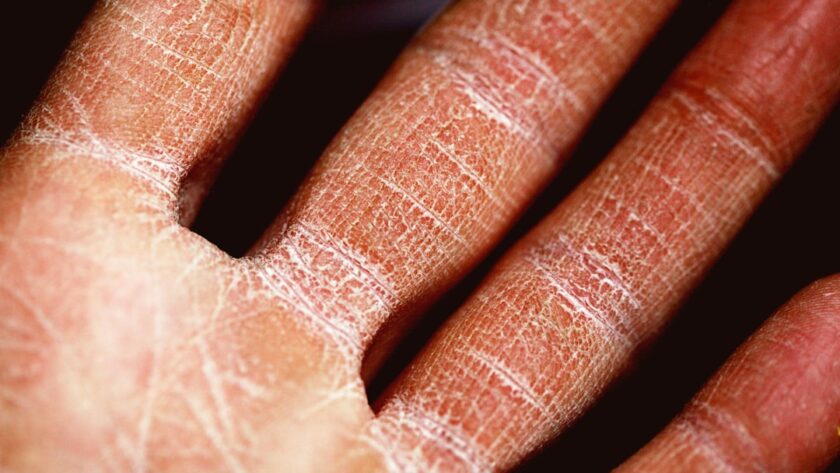 découvrez tout ce que vous devez savoir sur l'eczéma : causes, symptômes, traitements et conseils pour soulager cette affliction cutanée. apprenez à mieux gérer votre peau et à minimiser les poussées d'eczéma pour un confort quotidien.