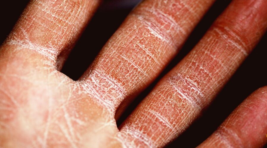 découvrez tout ce que vous devez savoir sur l'eczéma : causes, symptômes, traitements et conseils pour soulager cette affliction cutanée. apprenez à mieux gérer votre peau et à minimiser les poussées d'eczéma pour un confort quotidien.