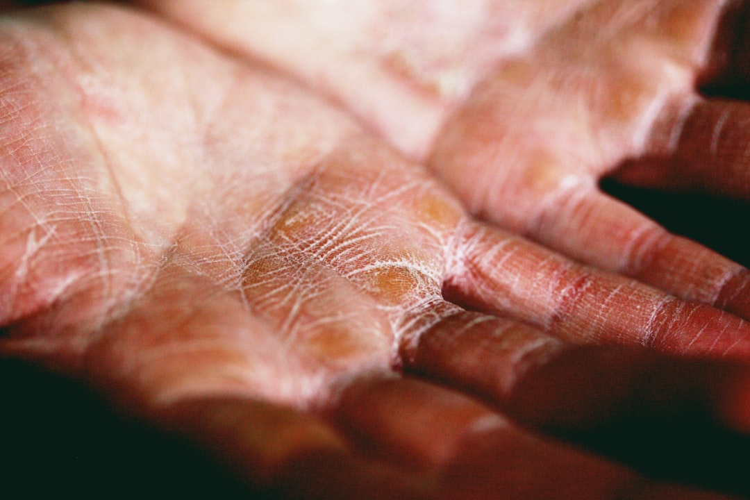 découvrez tout sur l'eczéma, ses causes, symptômes et traitements. informez-vous sur les meilleures pratiques pour soulager les démangeaisons et améliorer votre qualité de vie.
